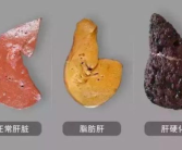 肝网红,探寻肝脏健康的秘密与守护之道